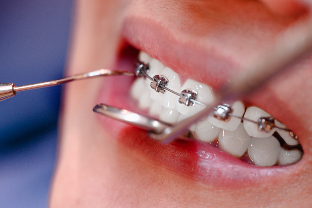 Tratamientos de Brackets Dentista en Horta Barcelona