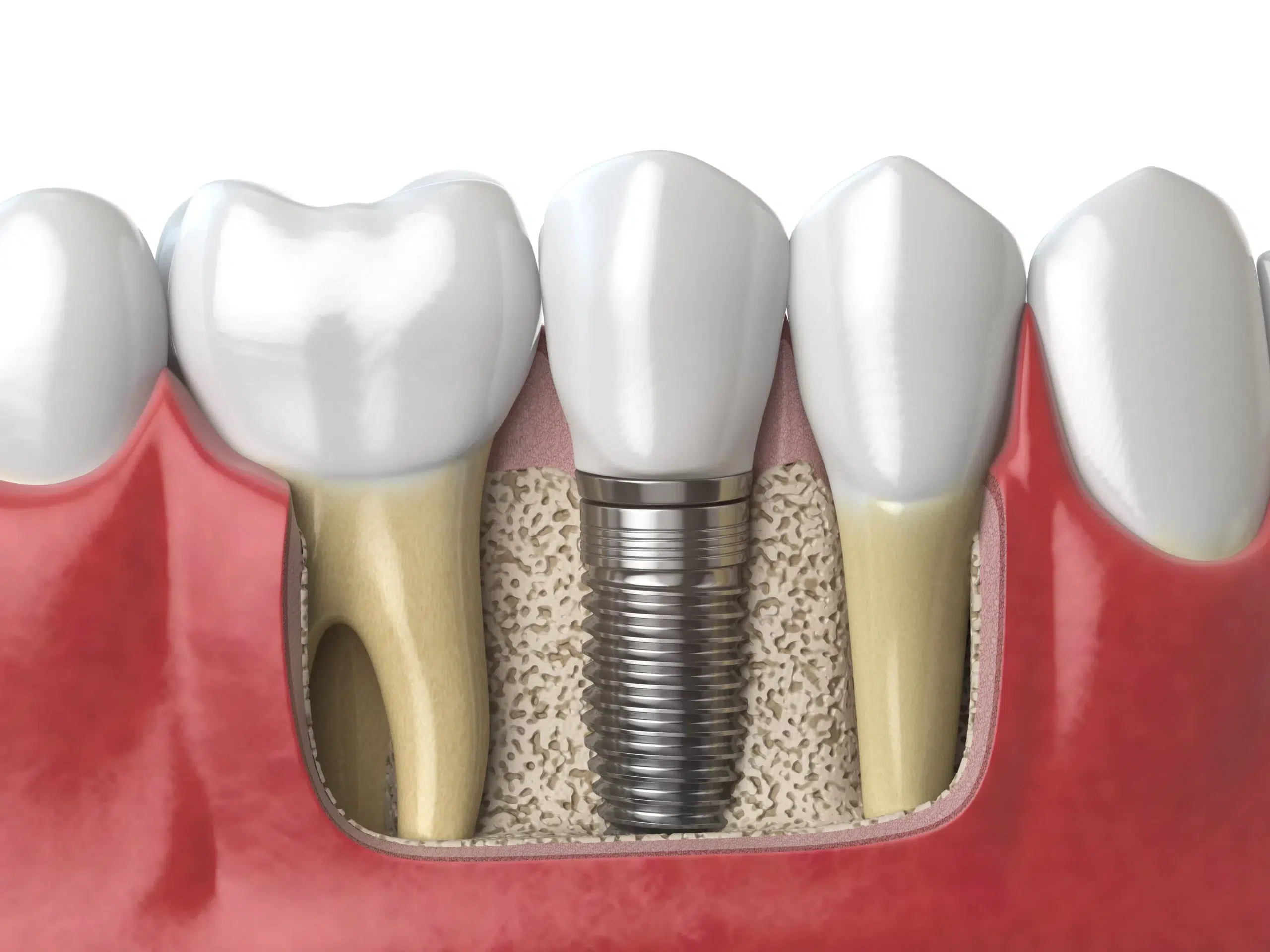 implantología, prótesis dental fija unitaria