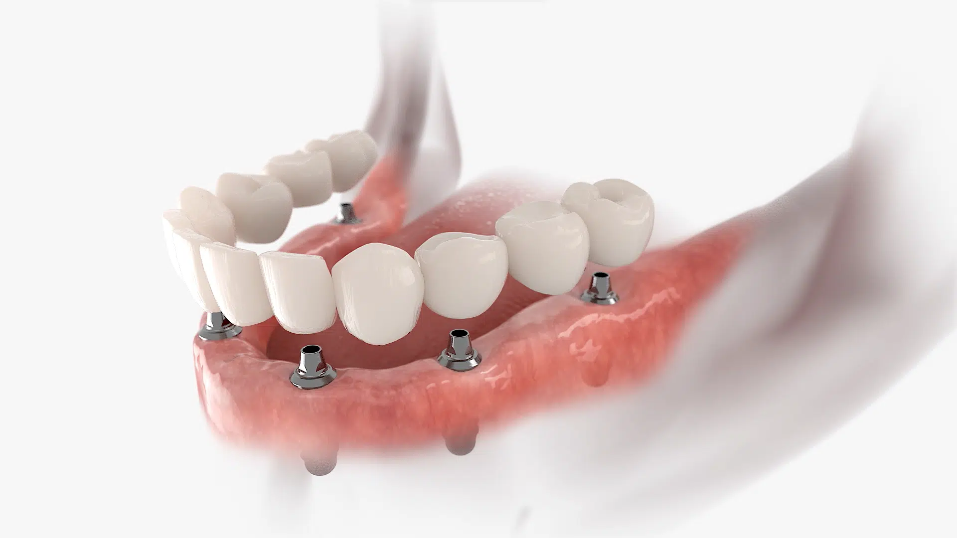 Implantología, prótesis dental fija