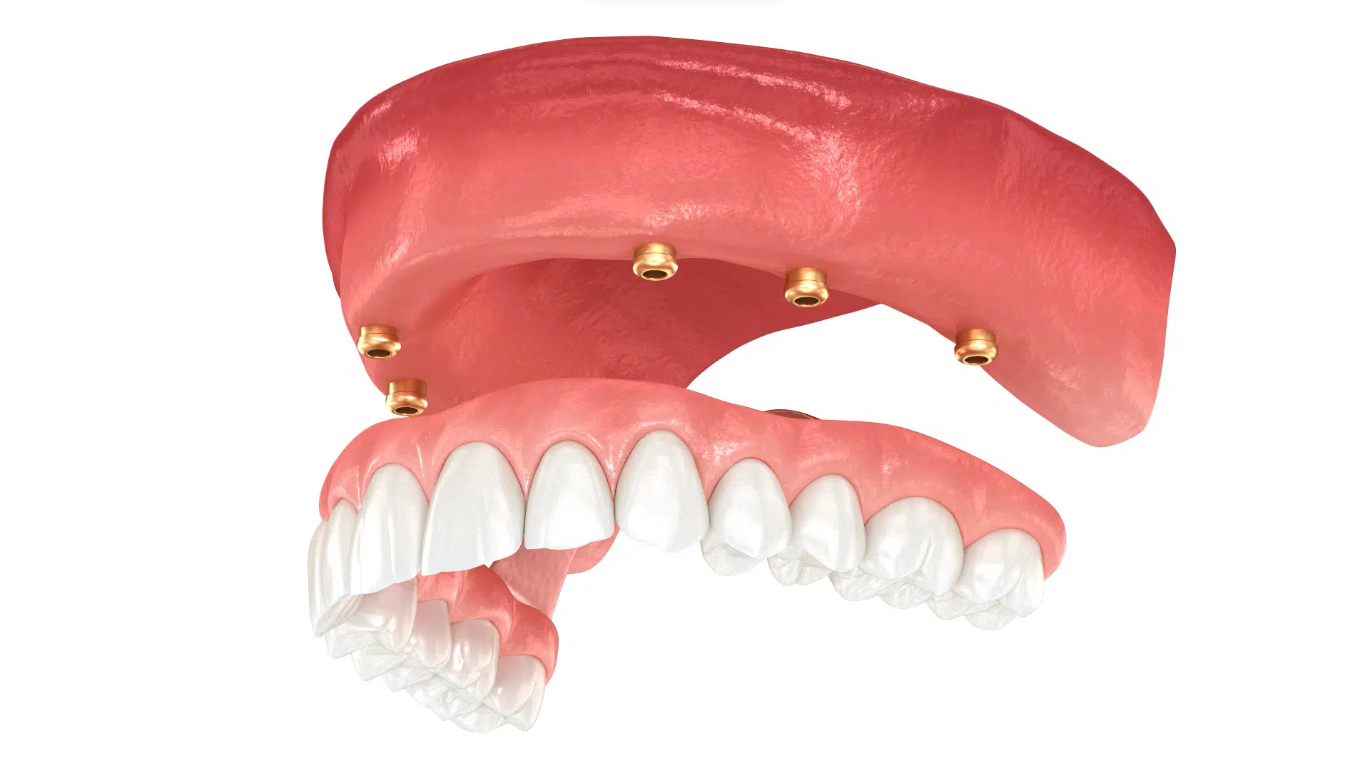 Implantología, prótesis dental híbrida