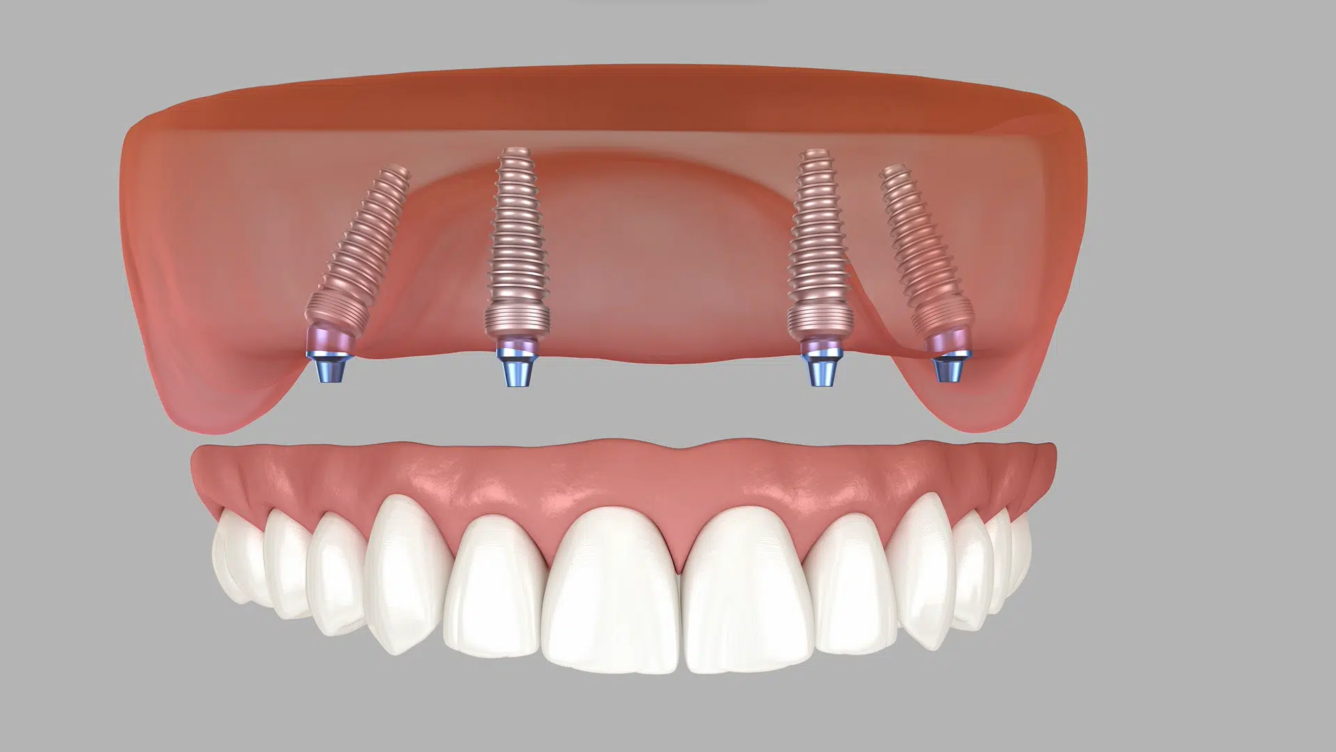 prótesis dental, espai dental