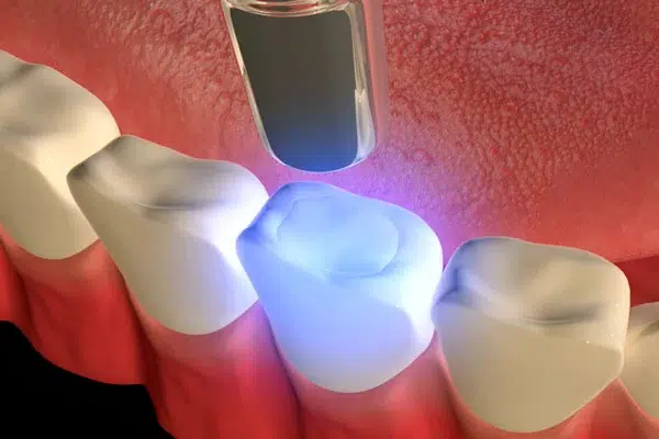 Empastes para la caries dental