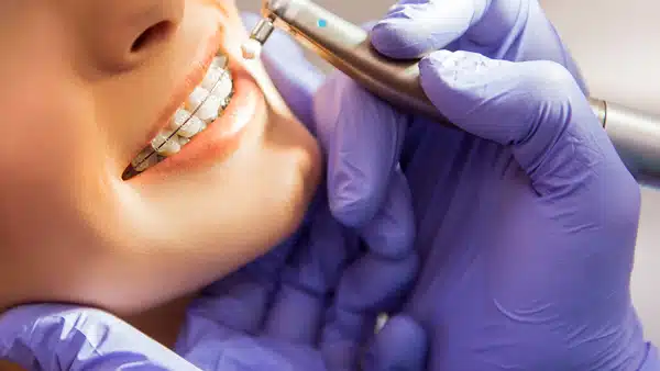 Ortodoncia con Brackets, clínica dental en Barcelona