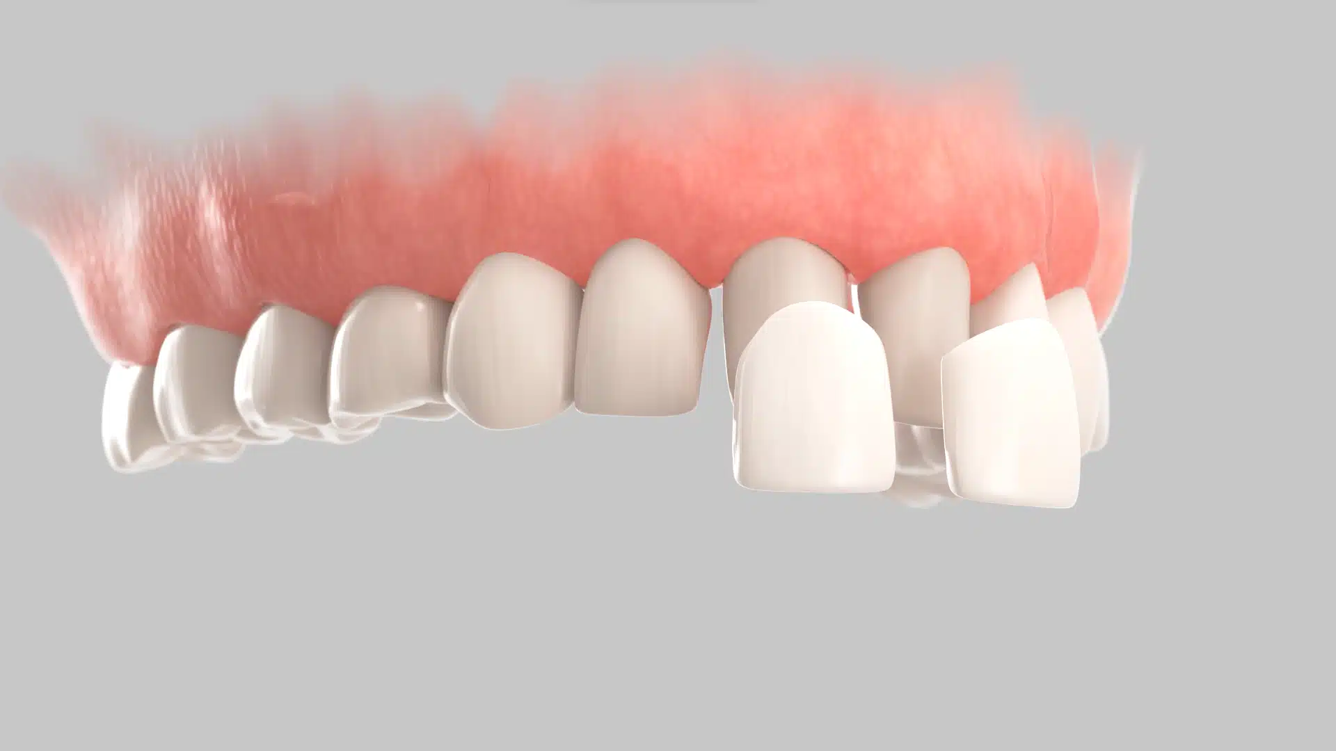 carillas dentales de composite