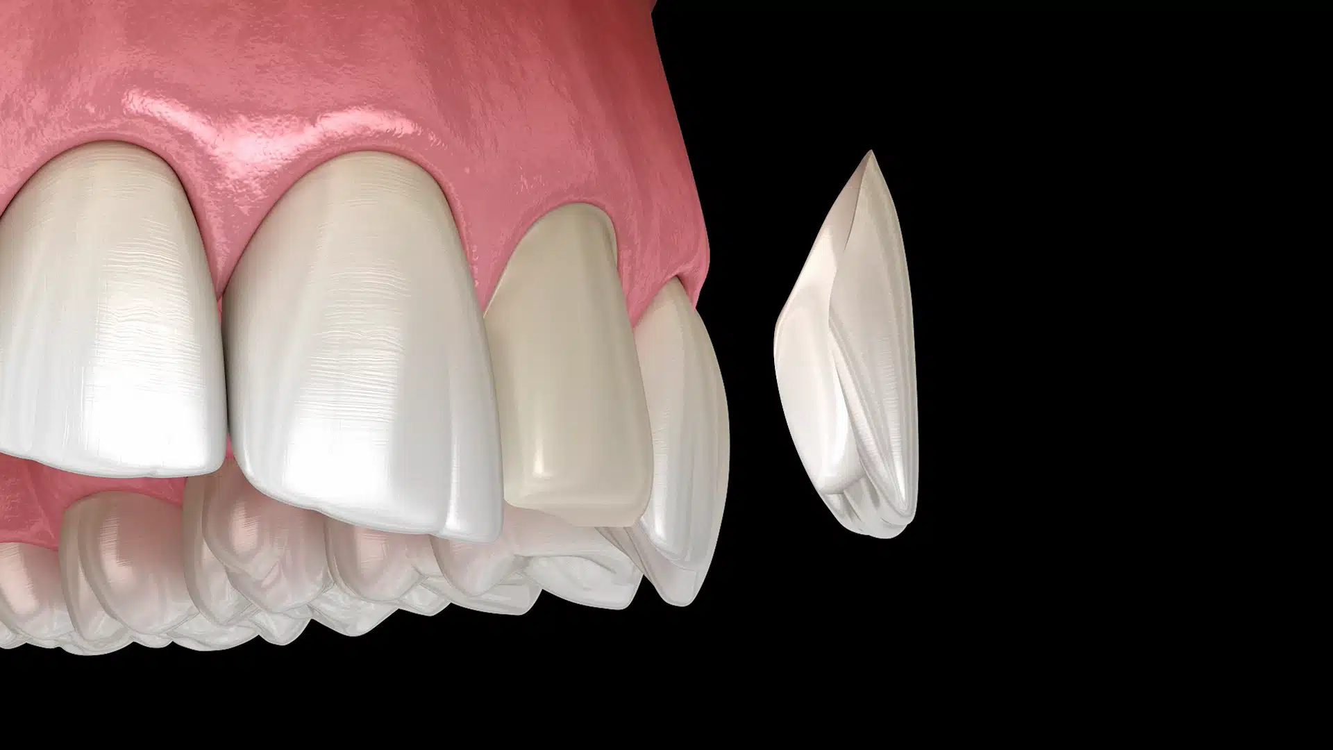 Carillas dentales de Composite